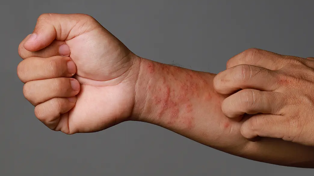 Bei Spätformen der Arzneimittelallergie bildet sich oft ein ausgedehnter Hautausschlag Großaufnahme von einem männlichen Handgelenk mit stark gerötetem Hautausschlag
