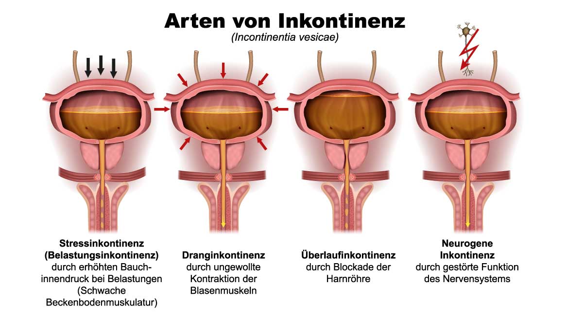 Verschiedene Formen der Harninkontinenz im Überblick