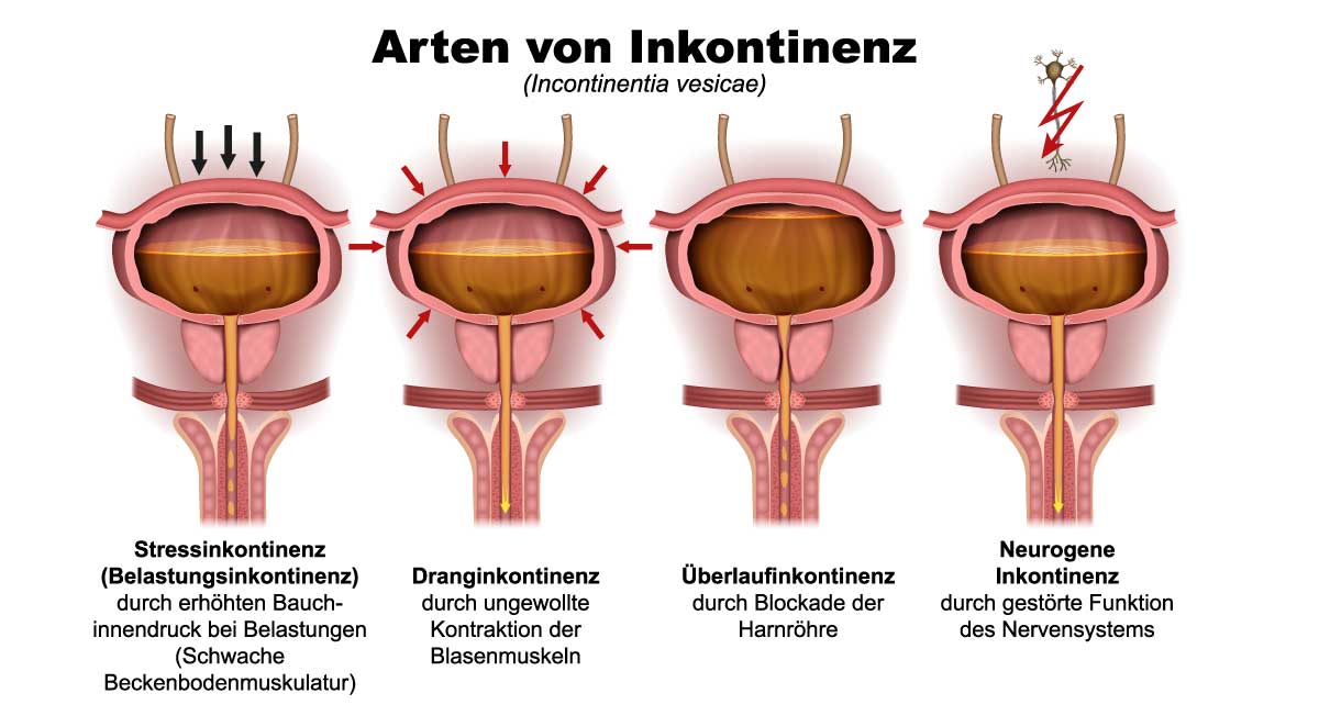 Verschiedene Formen der Harninkontinenz im Überblick