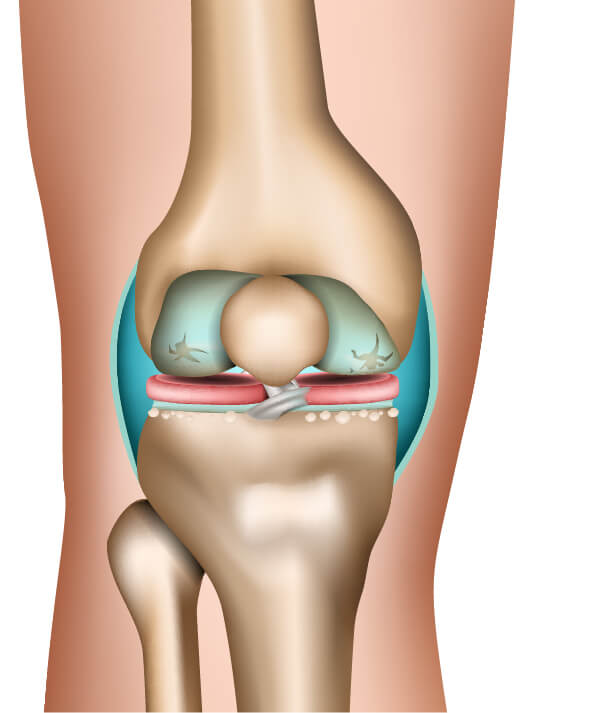 Die Stadien der Arthrose am Beispiel des Kniegelenks (3. Phase)