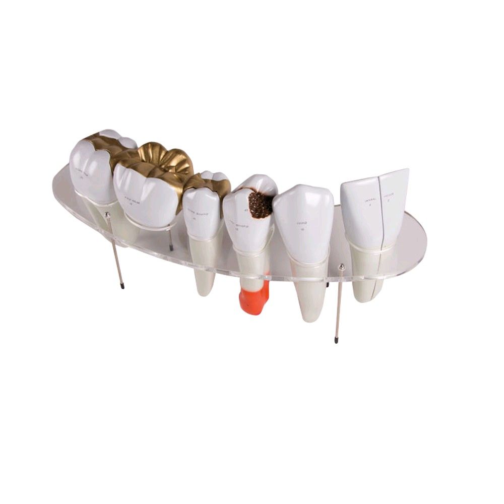 Zahnersatz-Modell von Erler Zimmer, 10-fache Größe, beschriftet