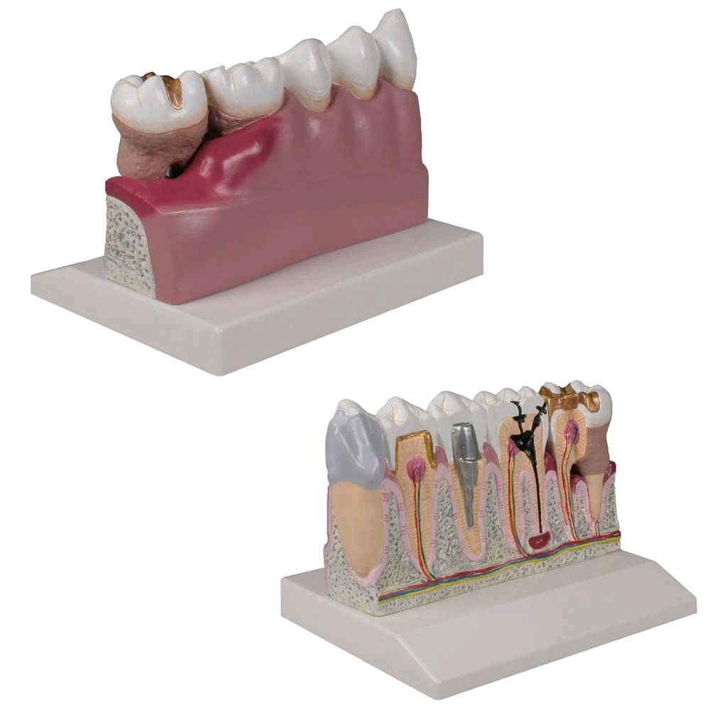 Dentalmodell von Erler Zimmer, Unterkiefer Zahn 3 -7, Erkrankung
