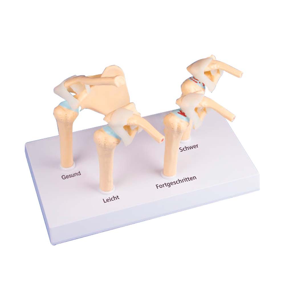 Erler Zimmer Modell - 4-Stadien-Osteoarthritis Schulter (OA)
