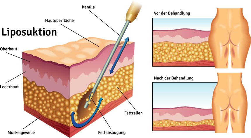  Grafische Darstellung der Liposuktion