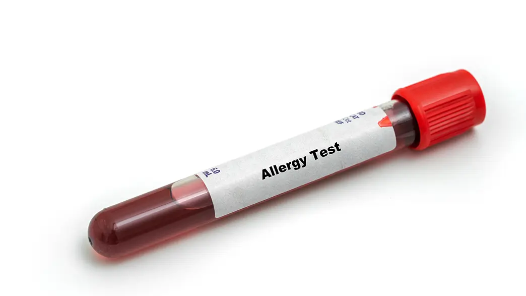 Verschiedene Allergietests von Hauttests bis zu Blutuntersuchungen dienen zur Diagnose von Medikamentenallergien Großaufnahme eines Probenröhrchens mit einer Blutprobe und der Aufschrift „Allergy Test