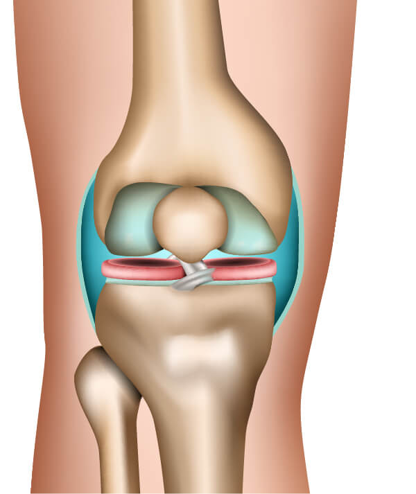 Die Stadien der Arthrose am Beispiel des Kniegelenks (1. Phase)