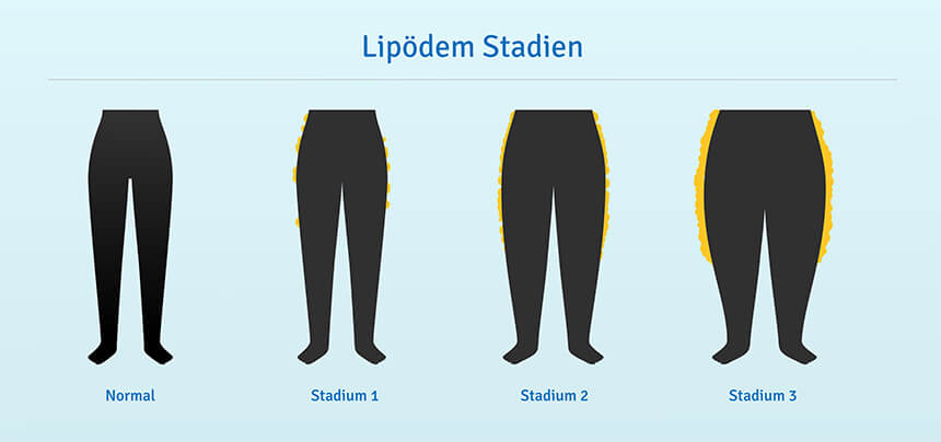 Fettablagerungen in den drei Stadien des Lipödems